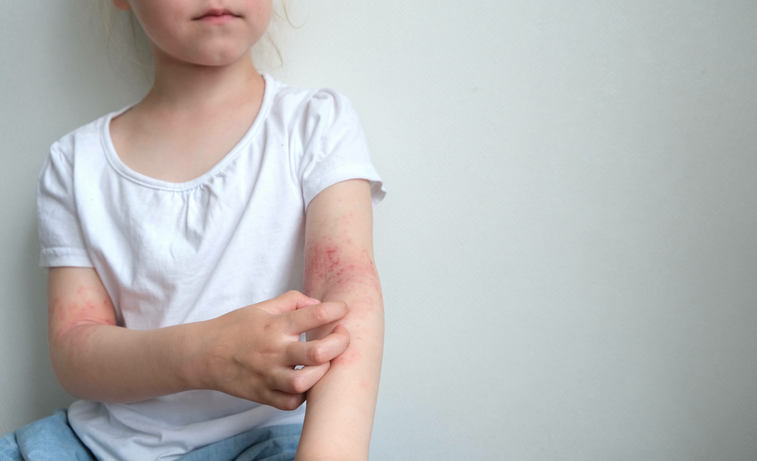 eczema enfant