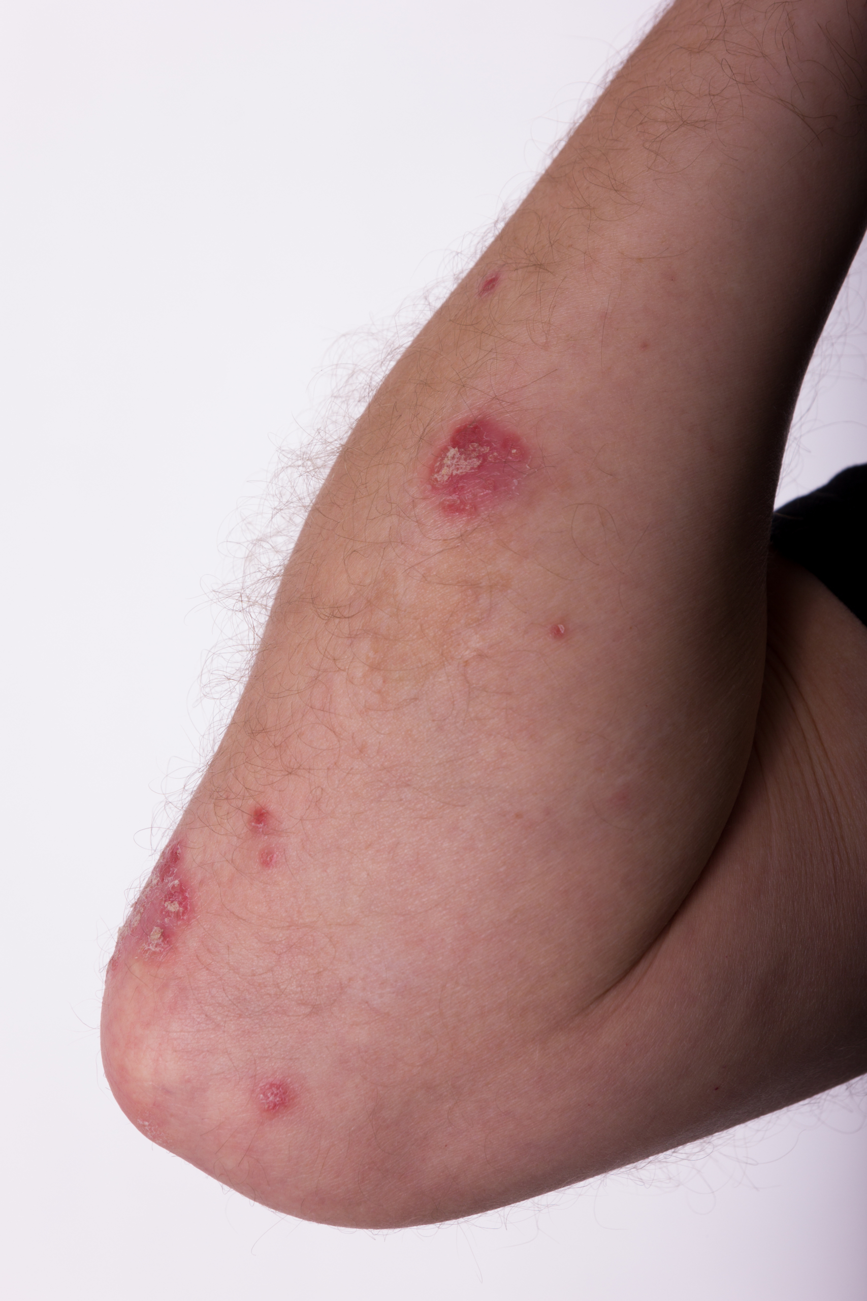 psoriasis en goutte